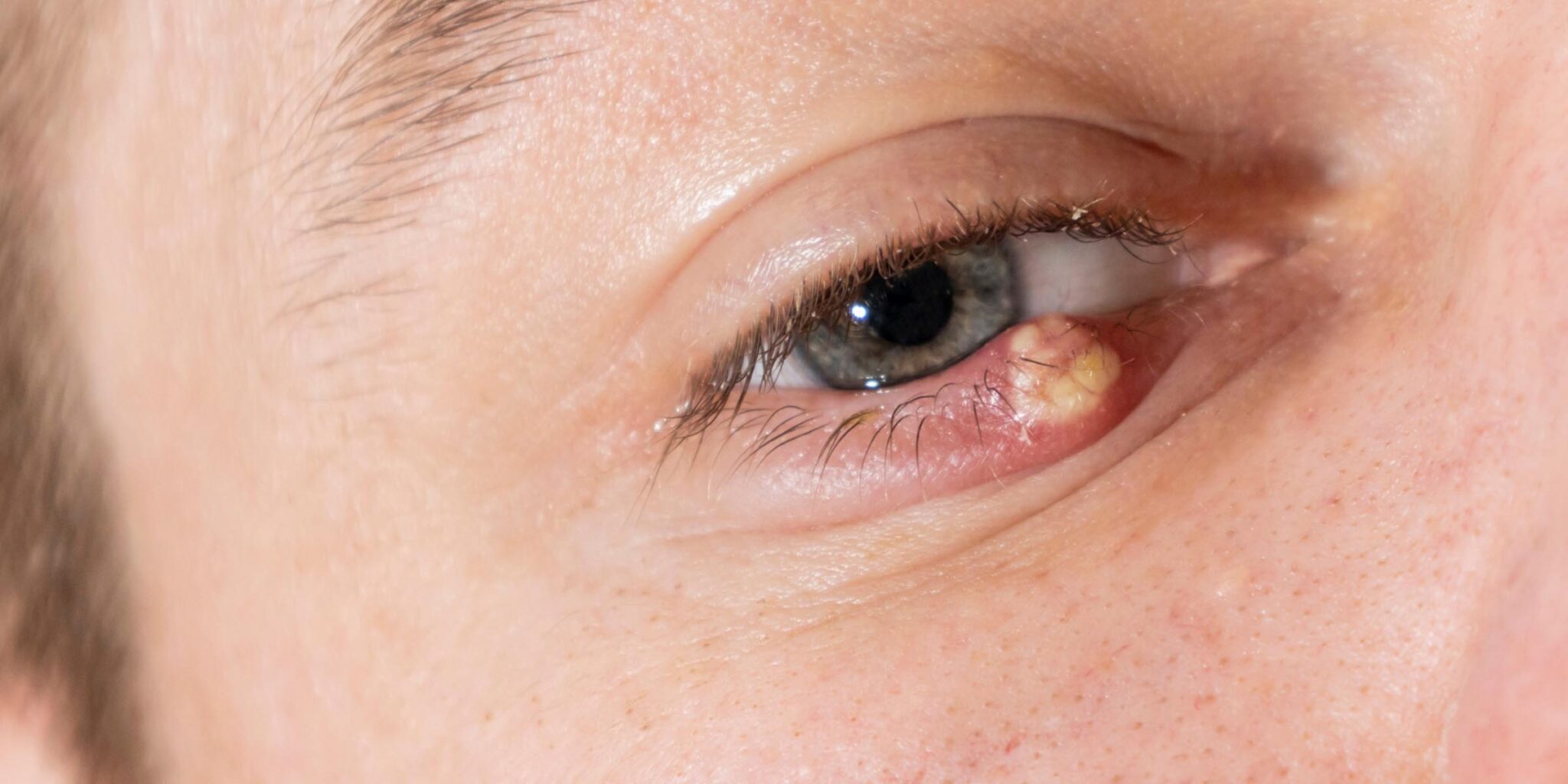 Chalazion und Hordeolum (Hagelkorn und Gerstenkorn) - Eyelaser - Eyelaser