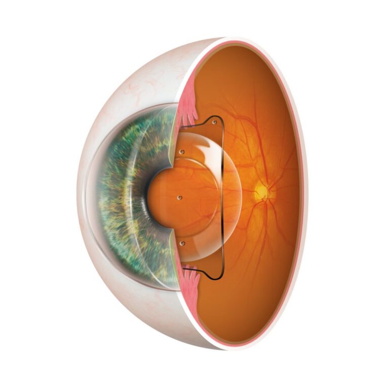 Illustration eines aufgeschnittenen Auges: Die EVO ICL liegt hinter der Iris und vor der eigenen Linse