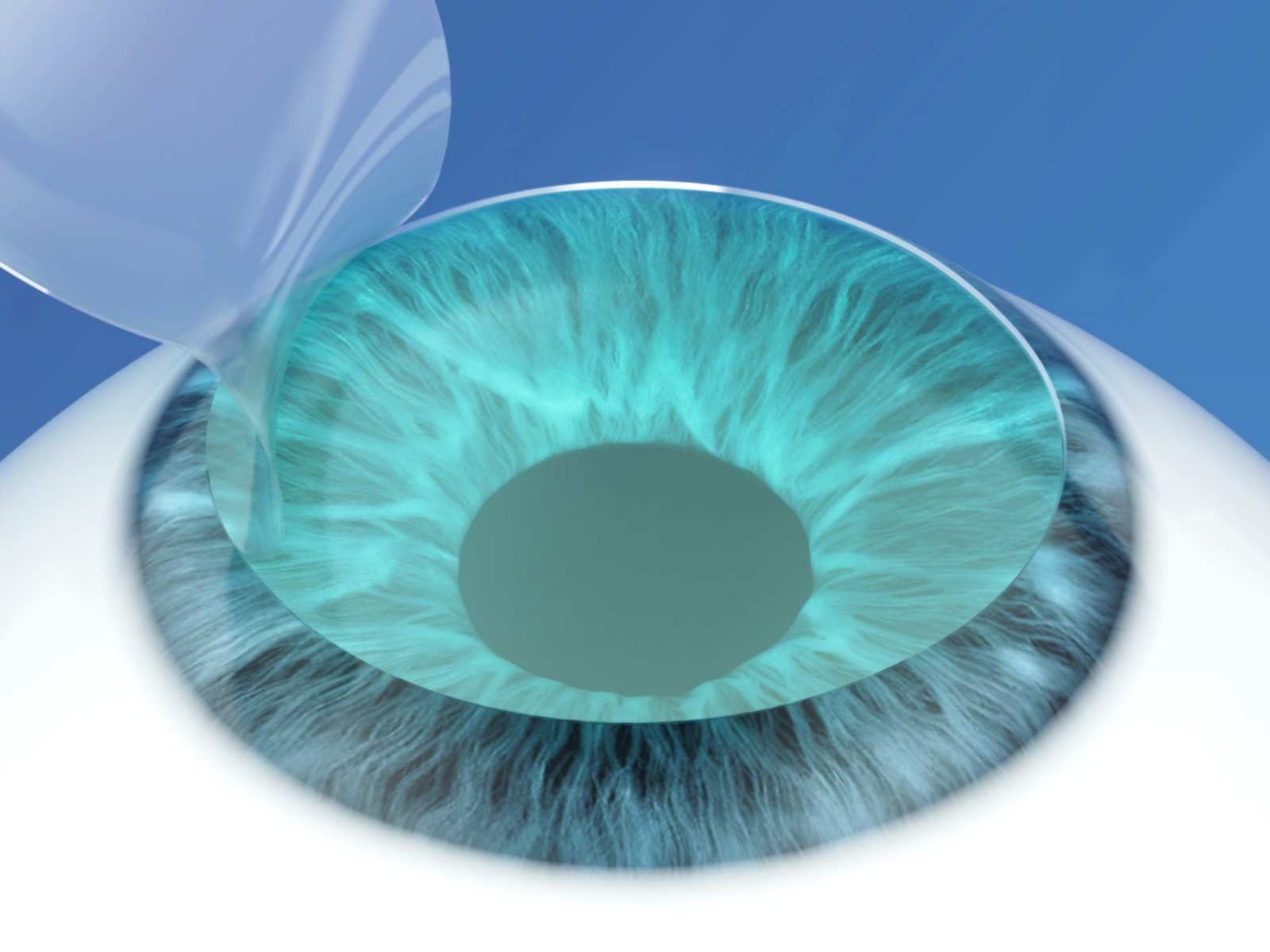 Ilustracja: w Femto-LASIK płatek wycięty laserem femtosekundowym zostaje uniesiony