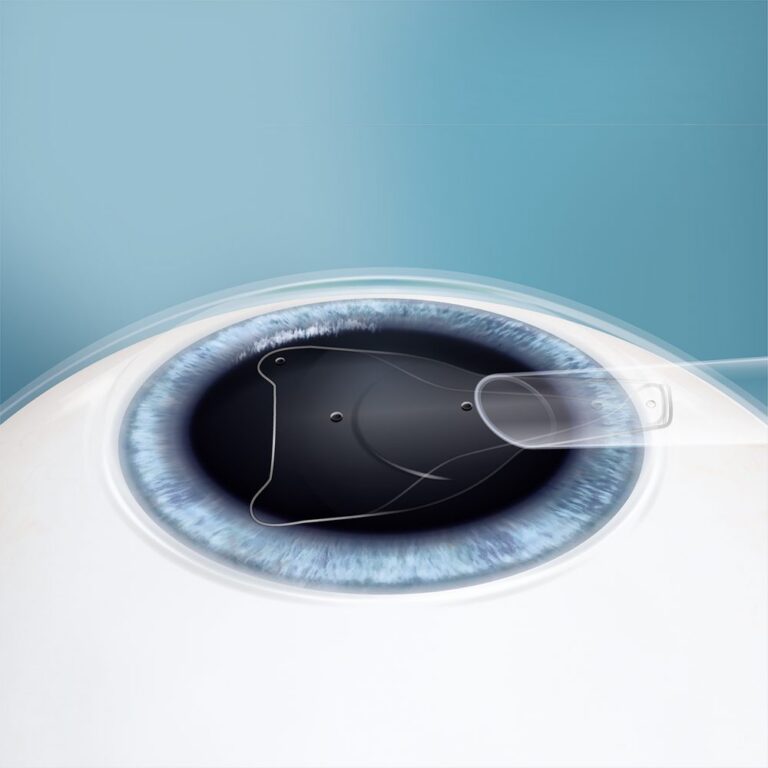 Illustration: Die eingerollte EVO ICL wird mit einem Injektor durch einen kleinen Zugang am Hornhautrand ins Auge gebracht