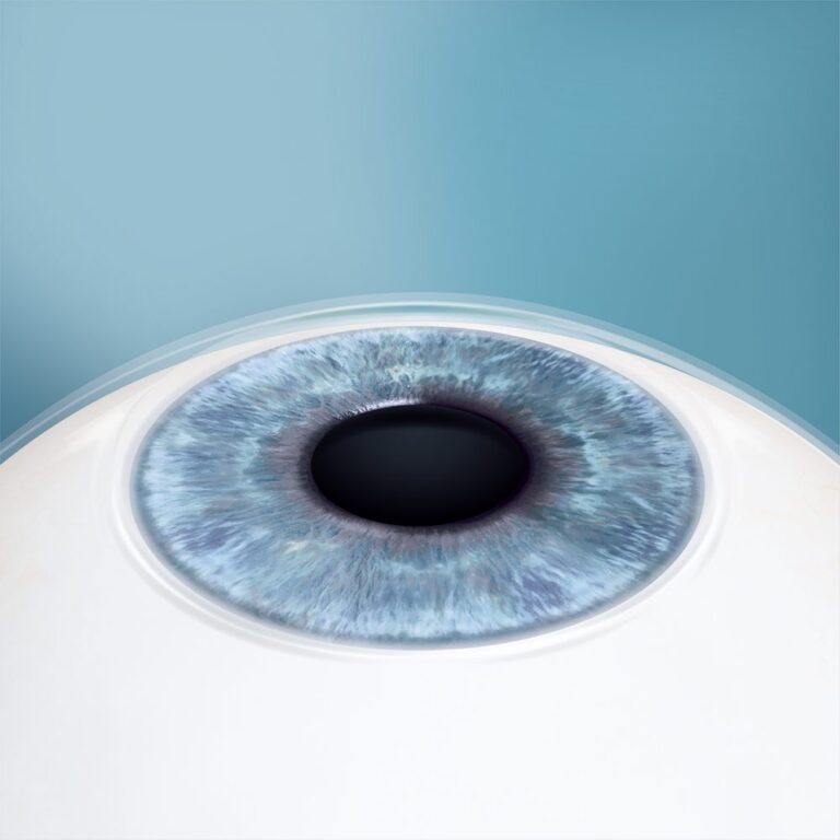 Illustration: Auge nach dem Eingriff mit enger Pupille, die Linse ist von außen nicht zu sehen