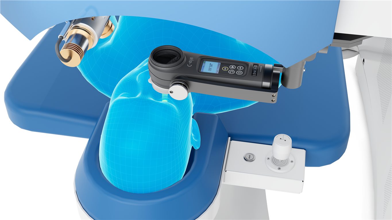 Crosslinking mit dem SCHWIND C-eye am Excimerlaser AMARIS 1050RS
