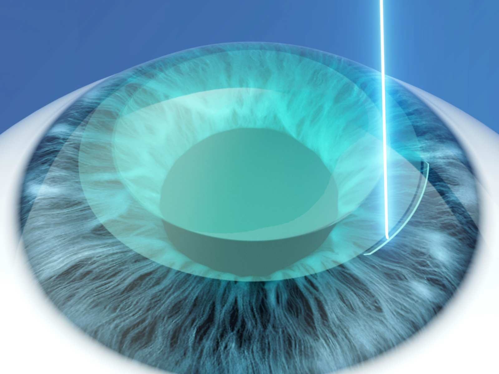 Illustration: small opening in the cornea for removing the lenticule in SmartSight