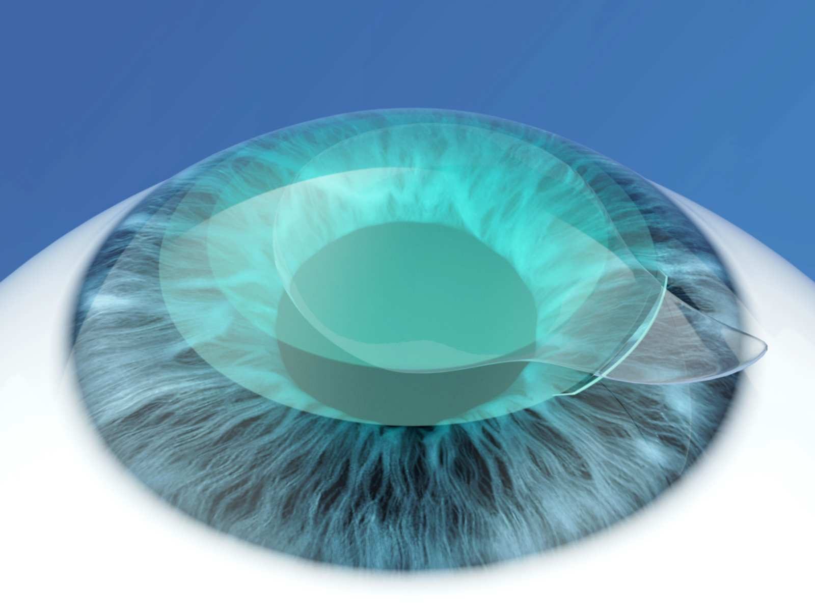 Illustration: the lenticule is removed from the cornea through the small opening