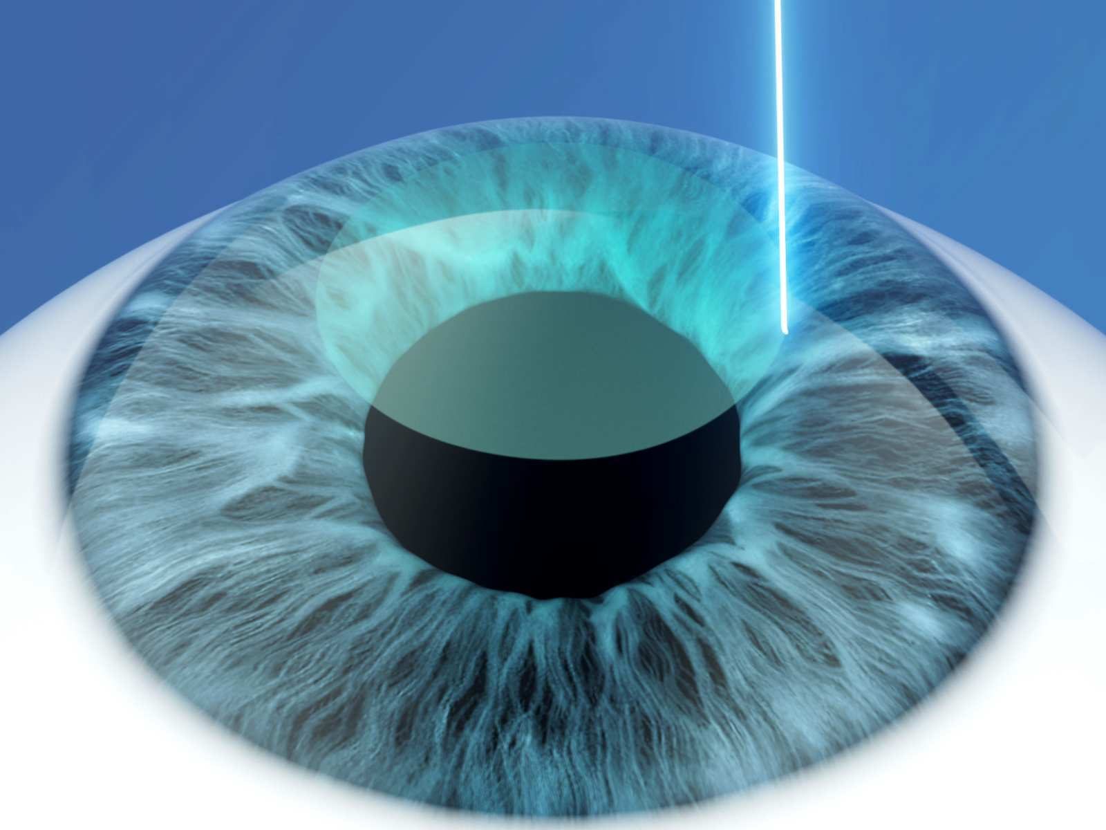 Ilustrație: la SmartSight, laserul femtosecundă formează un lenticul în cornee